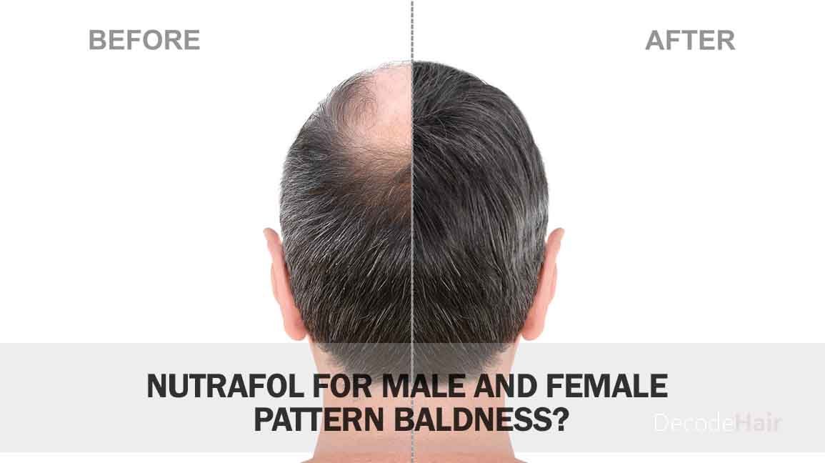Does Nutrafol Work for Male and Female Pattern Baldness