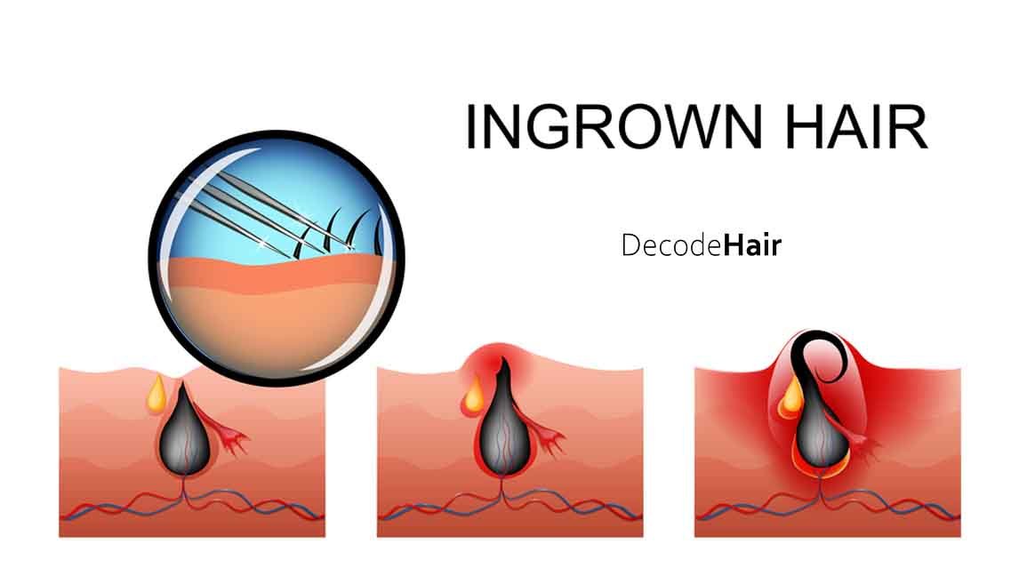 How to Treat Infected Ingrown Hair